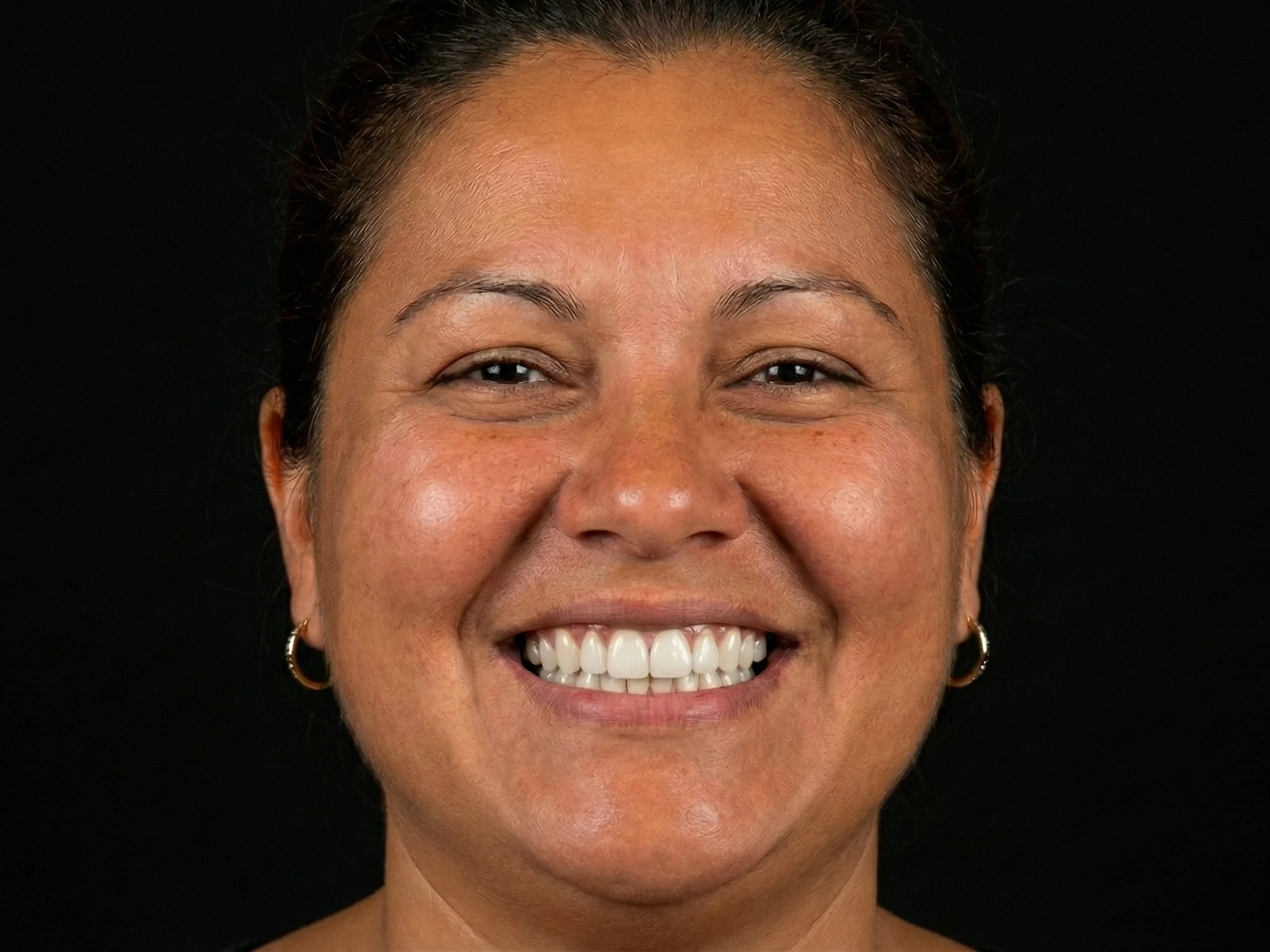 Full Arch Restoration